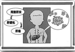 丙肝的症状有哪些,了解身体发出的警示信号