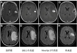肺癌脑转移,肺癌脑转移的病理机制与治疗策略探讨